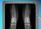 Leg-Lengthening Operation